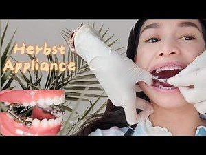 Attaching Lower part of my HERBST APPLIANCE and Braces Adjustment Vlog