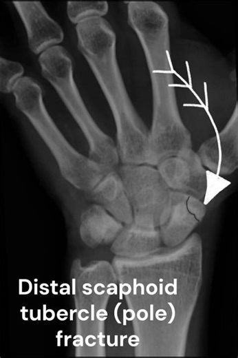 Distal scaphoid tubercle fracture