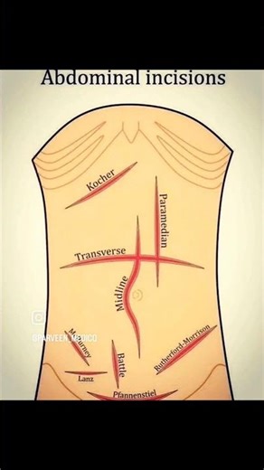 Types of Abdominal Incisions | Medical Surgery Guide👍#AbdominalIncisions #MedicalStudy #SurgeryGuide