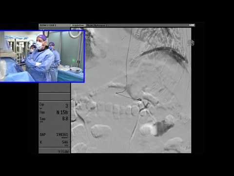 Transradial Coil Embolization of a Splenic Artery Aneurysm