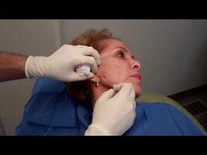 Silhouette InstaLift Threads with Dr Janowski