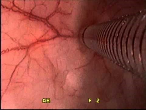 Cystoscopic Botox injections into the bladder.