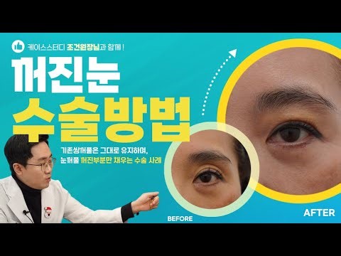 #상안검 #꺼진눈# 지방재배치 상안검 수술을 하면서 꺼진 눈을 해결할 수 있는 방법을 알려드립니다~!!!