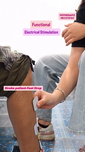 Foot drop results in a decreased quality of life, with unassisted movement becoming difficult or impossible. The increased risk of falls is particularly problematic as foot drop often affects the elderly or to those people whom falling already presents a great danger. Foot drop happens when dorsiflexors muscles of foot stop working or gets weaker or paralysed, Spasticity of opposite group of muscle is also one of the big reasons ! Functional electrical stimulation involves stimulating the weaken