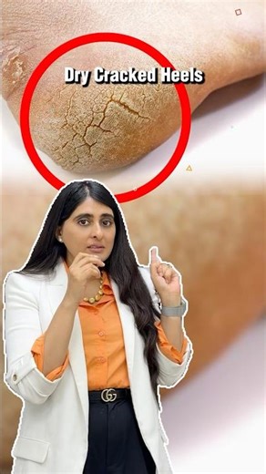 Crack Heel| Cracked Heel| Cracked heels Cream| Crack heel Cream| A Dermatologist's Guide|