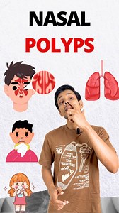 “Nasal polyps – they're more than just congestion!”�These small, non-cancerous growths in the sinuses can lead to sinusitis, allergies, rhinitis, asthma, and wheezing—and even worsen migraines. 😷 But I overcame them in childhood with a nature cure approach: detoxifying diet fasting. You can too! 🌿Avoid trigger foods and heal naturally. Join my Anti-Mucus Detox Program to breathe freely again.What Are Nasal Polyps?�They are soft, benign growths in sinus passages that block airflow, reduce smell