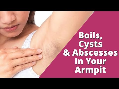 How To Treat Boils, Cysts and Abscesses in Your Armpit | Lumps in The Armpit