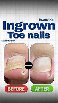Ingrown Toenail Removal || Pain Relief ingrown Toenail || Treatment Explained || by dr Anvika