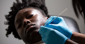 I Got An Extreme Blackhead Removal — & It Cleared My Acne