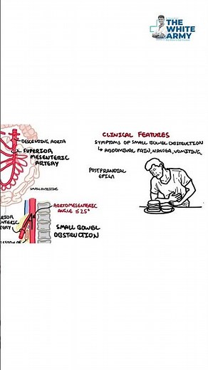 Superior Mesenteric Artery Syndrome