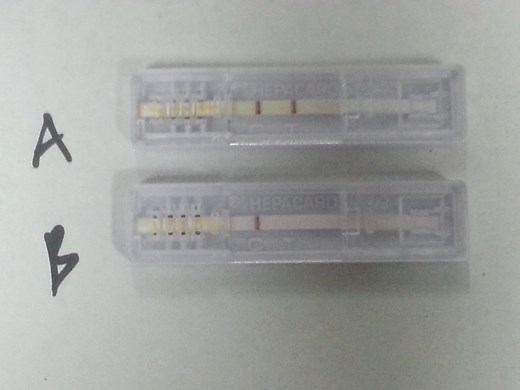 HBsAg test: Introduction, principle, procedure and result Interpretation