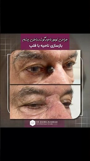 Medial canthal reconstruction using the combination of a glabellar flap and lower lid flap