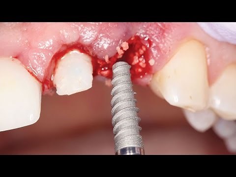 Immediate, Esthetic Tooth Replacement