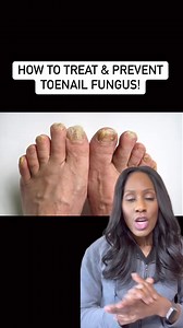 12K views · 148 reactions | How to treat & prevent toenail fungus! #onychomycosis | Dr. Jen Caudle | Facebook