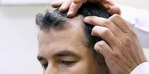 What Is Syphilis Hair Loss And How To Treat It?