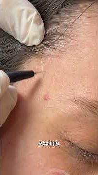 Sebaceous Hyperplasia