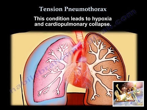 Tension Pneumothorax - Everything You Need To Know - Dr. Nabil Ebraheim