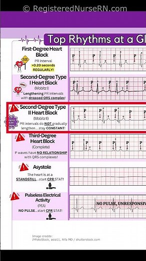 ECG (EKG) Rhythms to Know: Sinus Rhythms, Sinus Tachycardia, Heart blocks, etc.