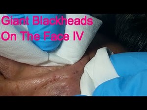 Giant Blackheads - Part IV-