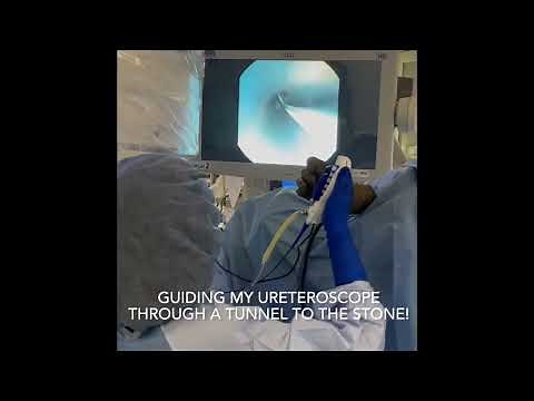 Ureteroscopy with Laser Lithotripsy | Treating Kidney Stones | Real Procedure Footage