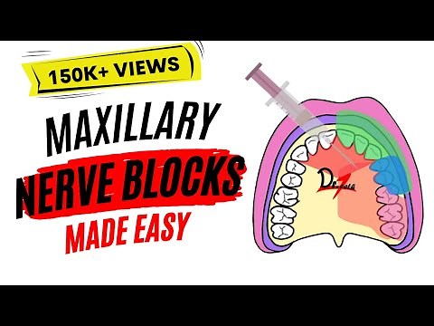 Maxillary Nerve Block: Anesthesia For Dental Procedures