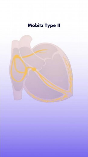 Second Degree Heart Block - Mobitz Type II