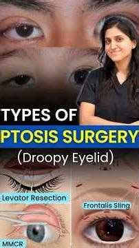 Types of Ptosis Surgery (Droopy Eyelid) || Levator, MMCR & Frontalis Sling Surgery