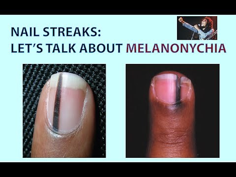 Streaks in Your Nails? Let's Talk about Melanonychia. We'll Also Look at Skin Tags & Skin Polyps