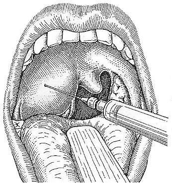 Définition | Phlegmon : qu'est-ce que c'est ? | Futura santé