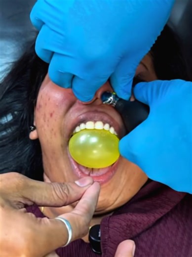Understanding Balloon Sinuplasty for Sinus Relief