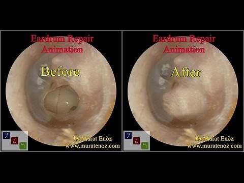 Ear Drum Repair