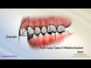 Malocclusion - Class II Div I