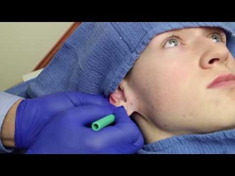 Earlobe Repair