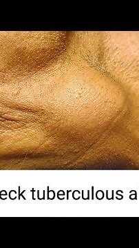 large neck abscess, incision n drainage,tb, patient with involuntary movement #dr #youtube #surgery