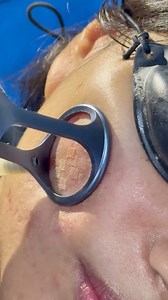 2.9K reactions · 143 shares | *Co2 Laser for Scars*  Bothered by...