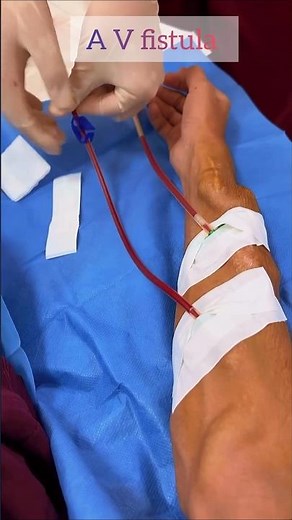AV fistula | arteriovenous fistula | what is av fistula