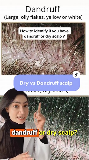 Dry vs Dandruff scalp - How to identify if you have dandruff or dry scalp ?