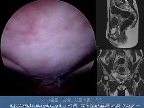 子宮底部筋腫子宮鏡下摘出術(TCR) Roller ball hysteroscopic technique for fundal submucous myoma