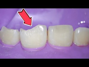 Broken Tooth Fixed with Bonding!