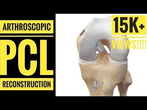Arthroscopic PCL (Posterior Cruciate Ligament)Reconstruction with Hamstring Graft