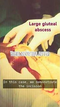 “Gluteal Abscess | Incision and Drainage Procedure Step-by-Step | Medical Case Video”