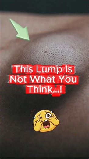 The Shocking Truth About GIANT Abscesses You Need to Know