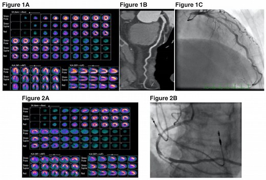 Exercise Stress Myocardial Perfusion Imaging — SozoCardiology - Dr Ooi Yau Wei Interventional Cardiologist