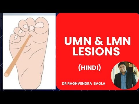 UMN vs LMN – Most Confused Neurology Topic
