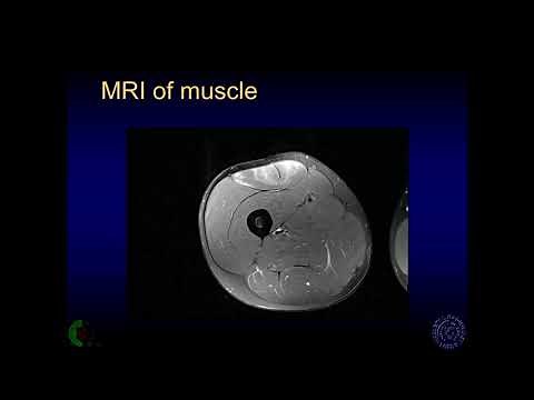 Imaging of muscle injury