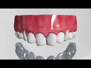 Invisalign 3D Animation