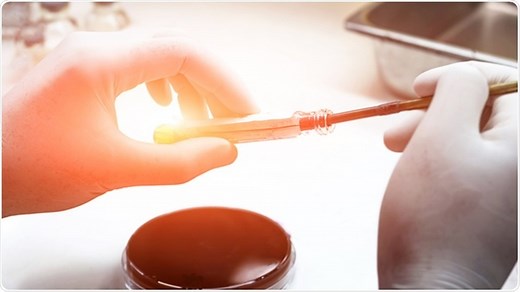 Lactate Levels and Sepsis