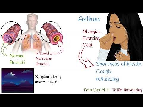 Asthma Symptoms and Treatment - Explained under 4 minutes.