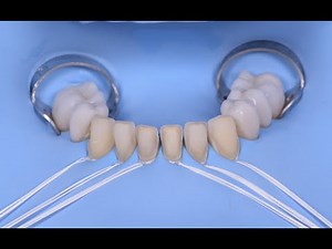 Ceramic Veneer adhesive cementation: the no finishing concept.