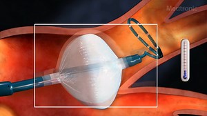 3K views · 66 reactions | ❄️Cryoballoon Cardiac Ablation❄️ Here are...